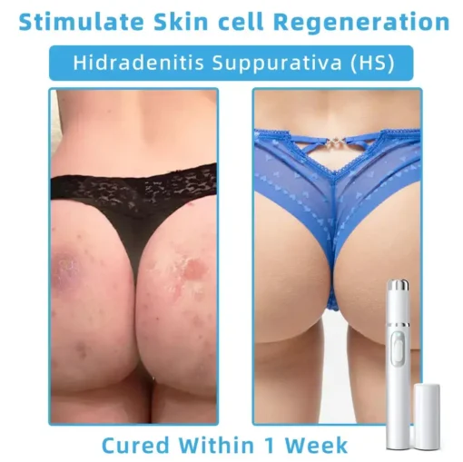 Jilvax™ ClearSkin Pen