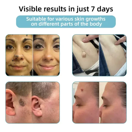 Jilvax™ ClearSkin Pen