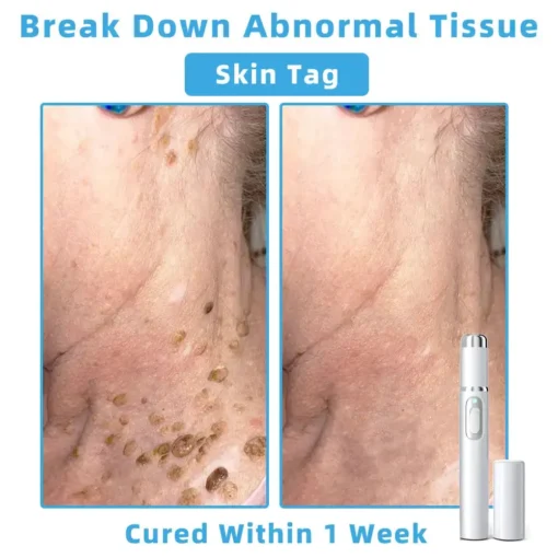 Jilvax™ ClearSkin Pen