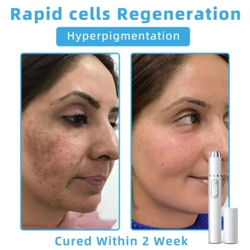 Jilvax™ ClearSkin Pen
