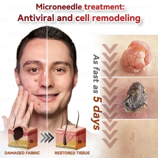 CZTICLE® Microneedles Botanical Skin Tags Solution Patches