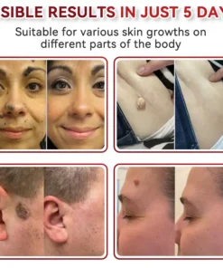 CZTICLE® Microneedles Botanical Skin Tags Solution Patches