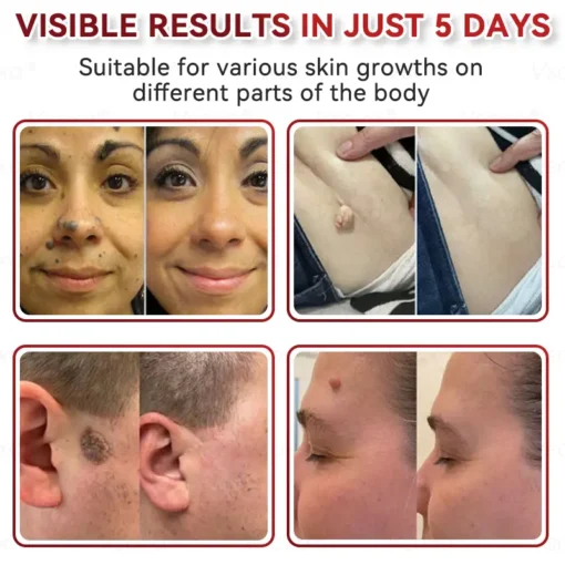 CZTICLE® Microneedles Botanical Skin Tags Solution Patches