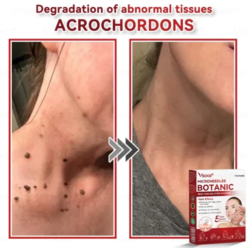 CZTICLE® Microneedles Botanical Skin Tags Solution Patches