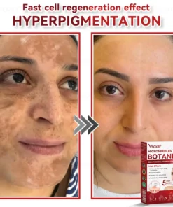 CZTICLE® Microneedles Botanical Skin Tags Solution Patches
