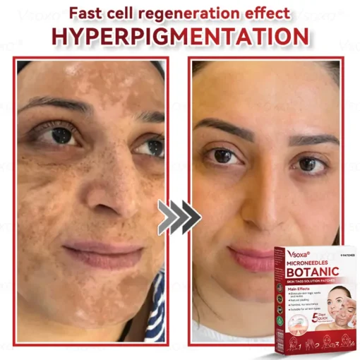 CZTICLE® Microneedles Botanical Skin Tags Solution Patches
