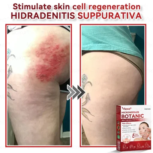 CZTICLE® Microneedles Botanical Skin Tags Solution Patches